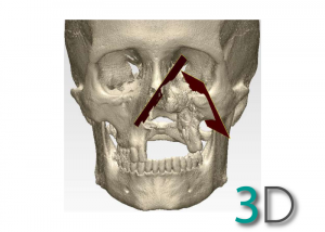 Implantes 3D - PSI