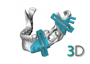 Surgical Planning (3D)